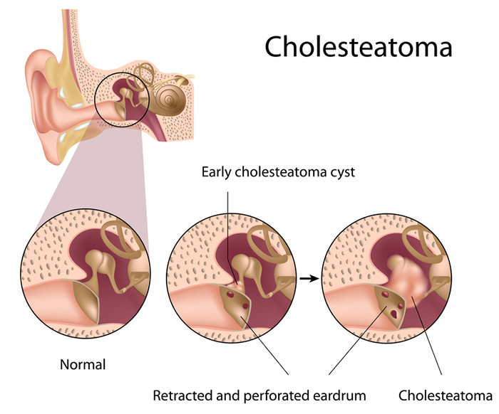 Causes and Treatments: Cholesteatomas | UC Irvine Medical Center