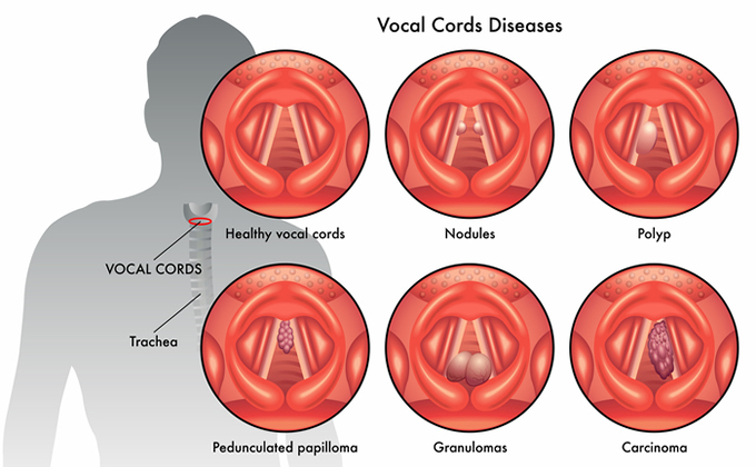 vocal nodules and singers